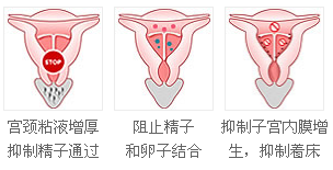 上环取环